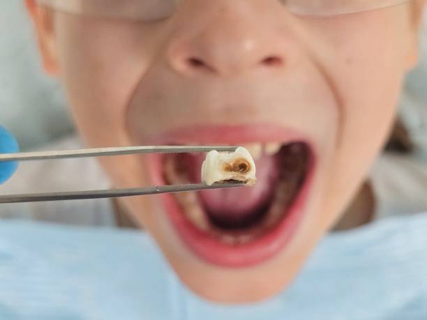Best Broken or Chipped Tooth Repair in Tenino, WA